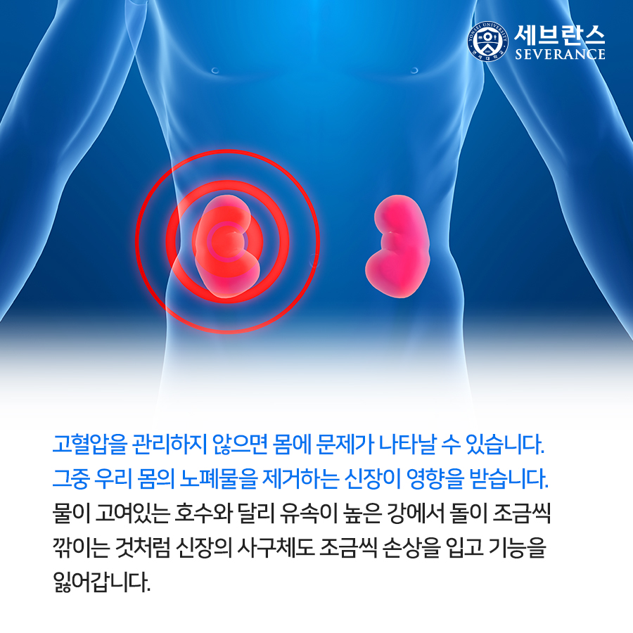 고혈압을 관리하지 않으면 몸에 문제가 나타날 수 있습니다. 그중 우리 몸의 노폐물을 제거하는 신장이 영향을 받습니다.  물이 고여있는 호수와 달리 유속이 높은 강에서 돌이 조금씩 깎이는 것처럼 신장의 사구체도 조금씩 손상을 입고 기능을 잃어갑니다.