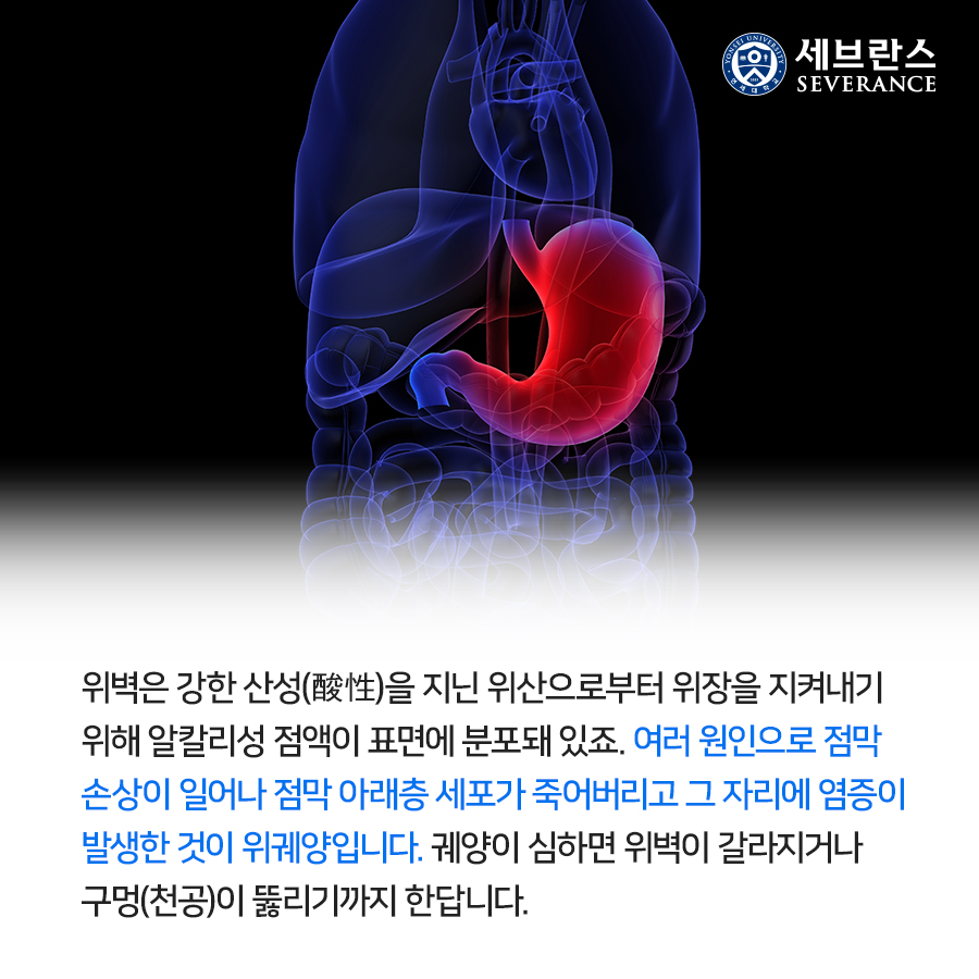 위벽은 강한 산성(酸性)을 지닌 위산으로부터 위장을 지켜내기 위해 알칼리성 점액이 표면에 분포돼 있죠. 여러 원인으로 점막 손상이 일어나 점막 아래층 세포가 죽어버리고 그 자리에 염증이 발생한 것이 위궤양입니다.  궤양이 심하면 위벽이 갈라지거나 구멍(천공)이 뚫리기까지 한답니다.