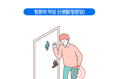 항문의 악성 신생물(항문암)